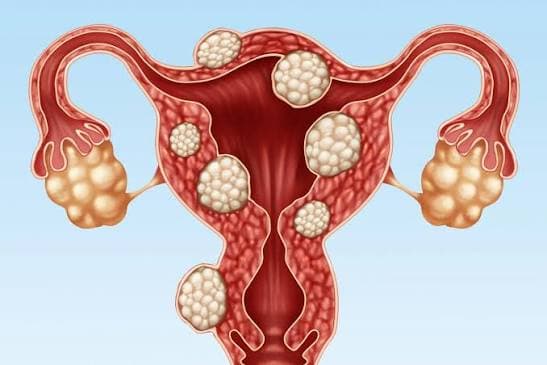 Uterine Fibroids: A Major Health Concern for Women