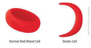 Nigeria Leads Global Sickle Cell Disease Cases in Children